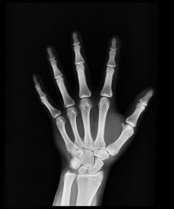 One of the most common health issues among seniors is arthritis and bone loss.