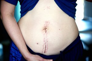 Caucasian stomach with a surgery scar startinf above the belly button, going sraight down.