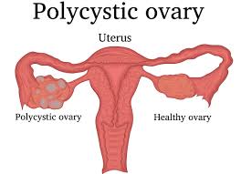 Drawing of uterus and ovaries with cysts on one of them.