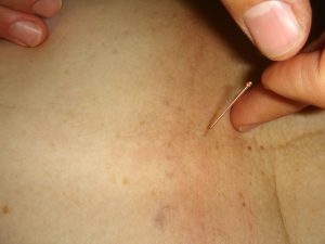 Needle being placed on skin.