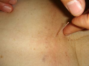 Needle being placed on skin. 