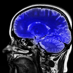 Xray of a person's head witht he brain colored blue.