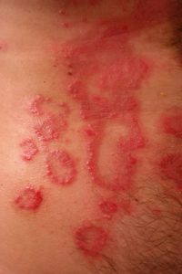 persons skin with a spotty rash