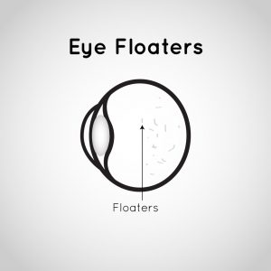 illustration of an eye and floaters