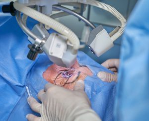 woman laying down with blue surgical mask over face ad lasers pointing at the eye