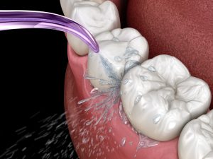 illustration of purple water flosser shooting water out onto teeth