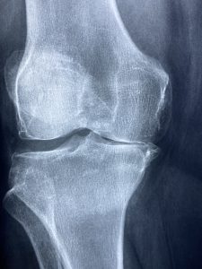 xray of a knee