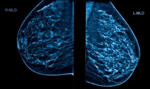 3D of breast tissue 