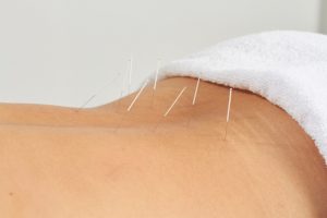 caucasian's lower back laying down with needles sticking in it