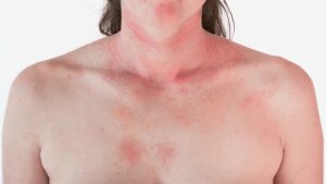 caucasian woman's chest with pink hives all over it