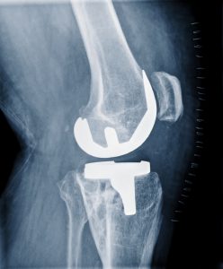 x-ray of a knee with plates in it