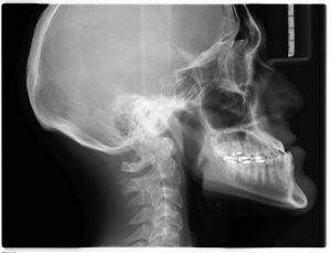 x-ray of a human skull