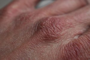 dry skin on the back of a caucasian hand's knuckles