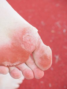 red inflamed bottom of a caucasian foot.