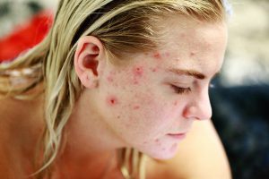 young caucasian woman's side of the face with acne all over it.