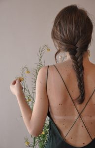 the back of a caucasian woman filled with birthmarks