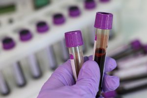 a persons hand with purple gloves on, holding 2 blood viles