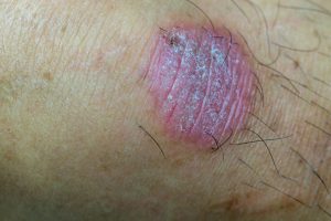 oval shaped dry patch of skin that is pink 