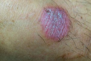 oval shaped dry patch of skin that is pink