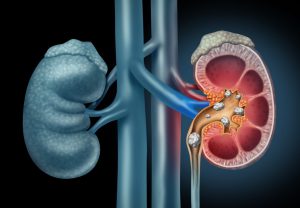 picture of the kidney with stones in it