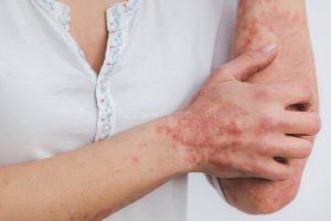 caucasian skin with a rash on the hand and elbow