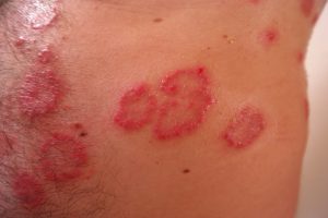 round patches of red rashes on the skin