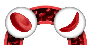 illustration of a regular red blood cell and a crescent red blood cell