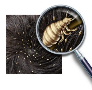 picture of head with lice on it and a magnifying glass over one