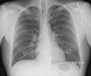 chest x-ray