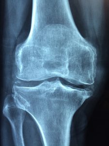 x-ray of a knee with arthritis
