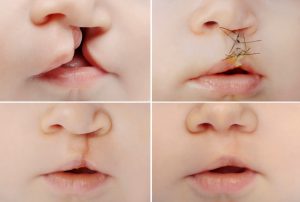 child's cleft lip stages of surgery treatment