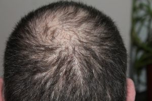 hair loss on a man's scalp