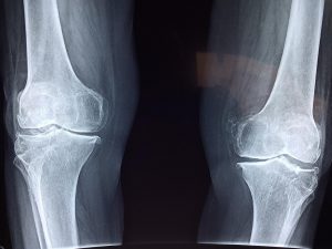 an Xray of knees