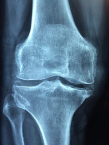xray of bones